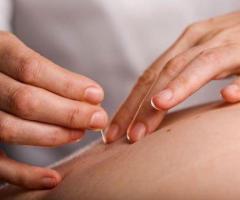 Best Acupuncture near San Marteo, CA