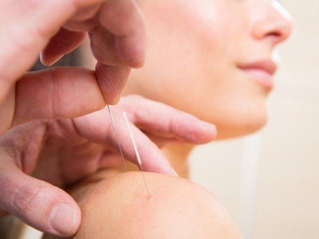 Best Acupuncturist in Burlingame, CA