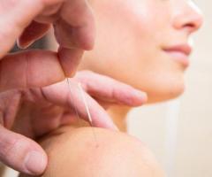 Best Acupuncturist in Burlingame, CA