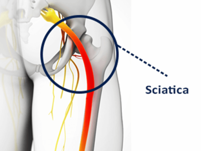 Shockwave therapy Brea