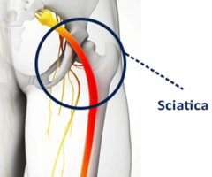 Shockwave therapy Brea
