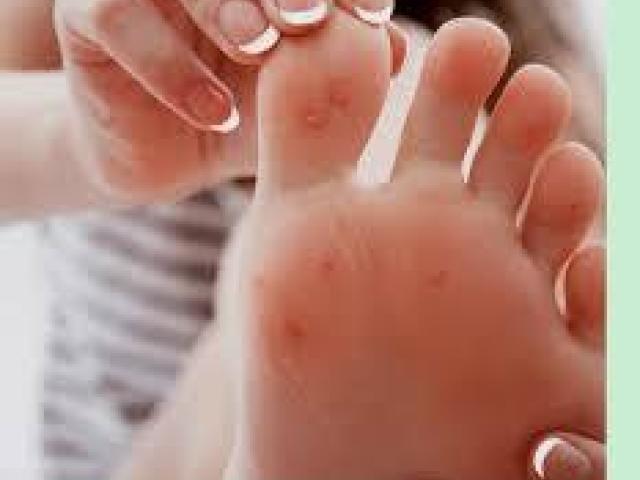 Plantar Wart Removal Doctor Perth Amboy