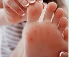 Plantar Wart Removal Doctor Perth Amboy