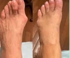 Bunion Specialist Elizabeth