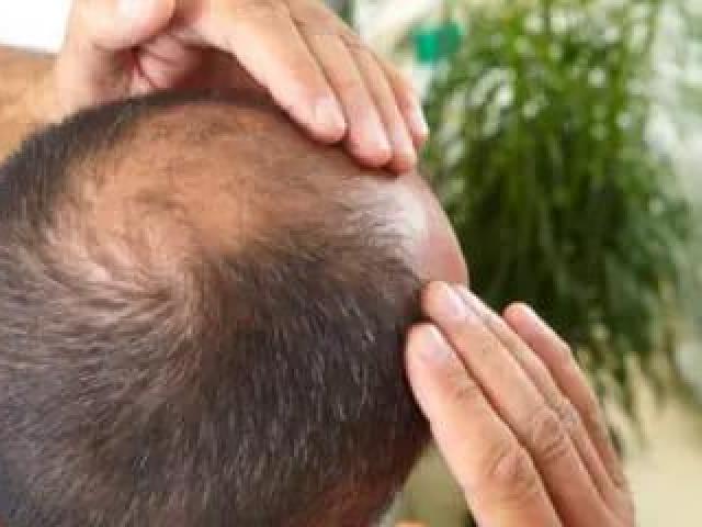Best Hair Fall / Hair Loss Treatment In Coimbatore