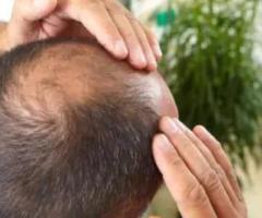 Best Hair Fall / Hair Loss Treatment In Coimbatore