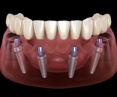 All-on-4 Dental Implants in Tijuana, Mexico – Affordable, Life-Changing Results!