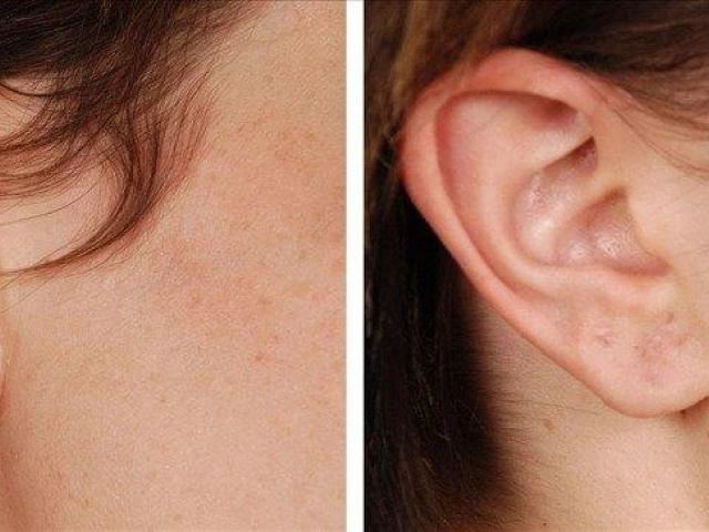 Resplendent Cosmetics – Earlobe Treatment in Delhi