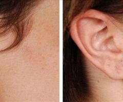 Resplendent Cosmetics – Earlobe Treatment in Delhi