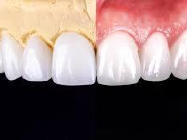 Bring back your true smile with our treatment of root canal in Tijuana