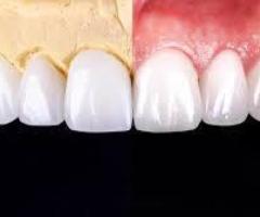 Bring back your true smile with our treatment of root canal in Tijuana